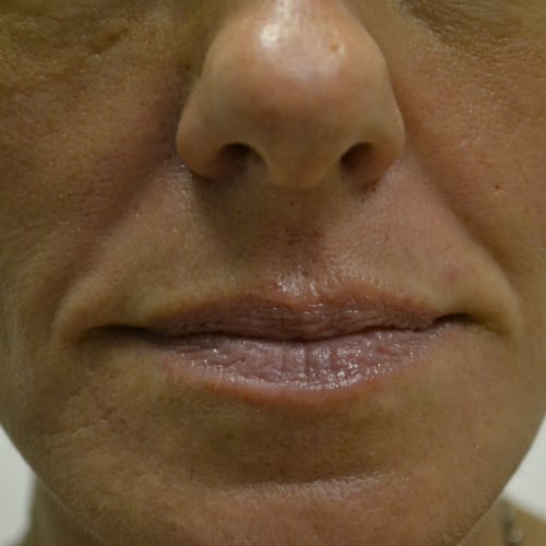 Nasolabial closeup before fillers case 948