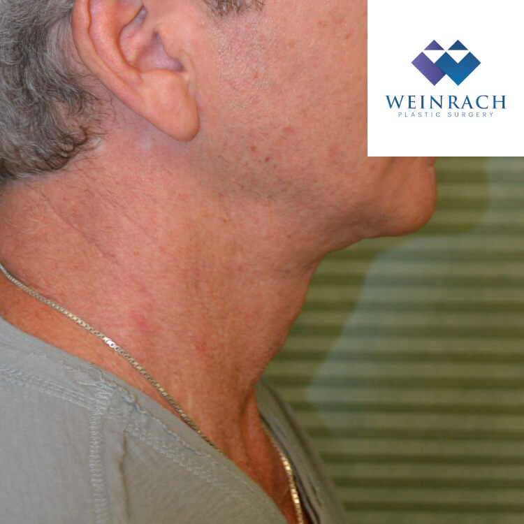 Neck lift after right side