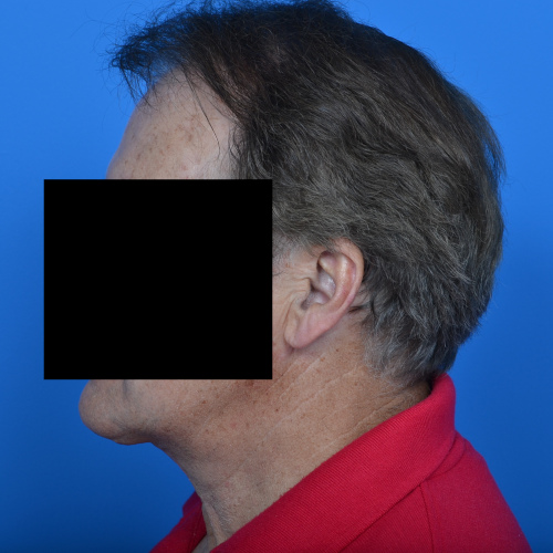 After necklift left profile view case 1032