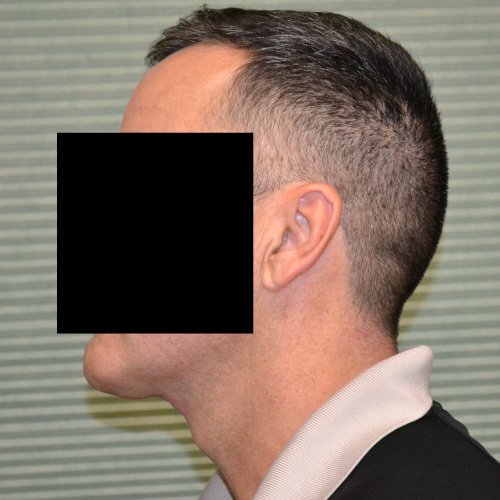 Male patient case 1049 after necklift left profile