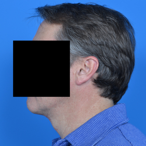 Left profile view of male patient after necklift case 1037