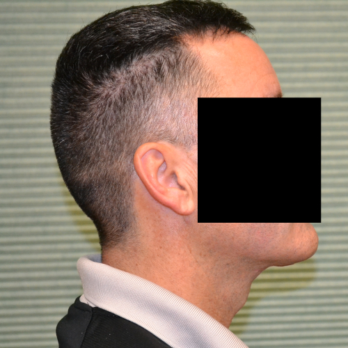 Male patient case 1049 after necklift right profile