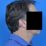 Profile view of male patient after necklift case 1037