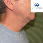 Neck lift before right side