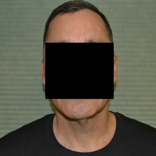 Male patient case 1049 after necklift front profile before