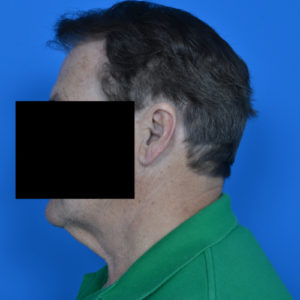 Male patient before neck lift left side case 1032