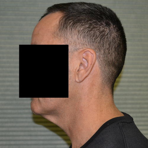 Male patient before neck lift left side case 1049