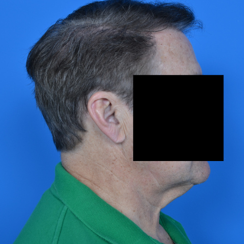 Male patient before neck lift right side case 1032