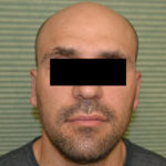 Male patient after otoplasty front view case 1054