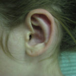 Left side view of ear after otoplasty case 1075