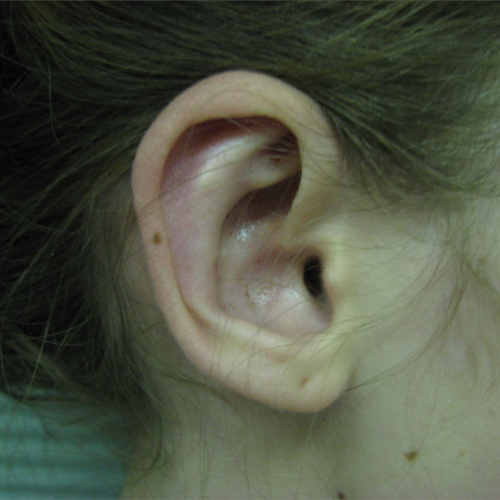 Right side view of ear after otoplasty case 1075