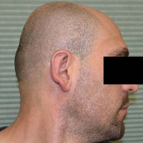 After otoplasty profile view case 1054