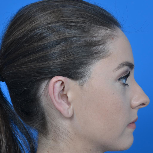 Side view of head after otoplasty 1068