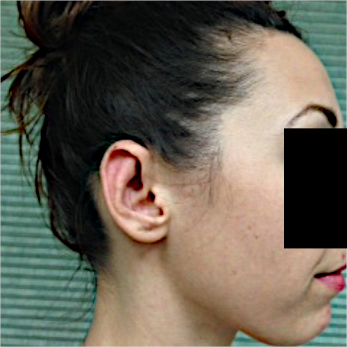 After otoplasty profile view case 1087