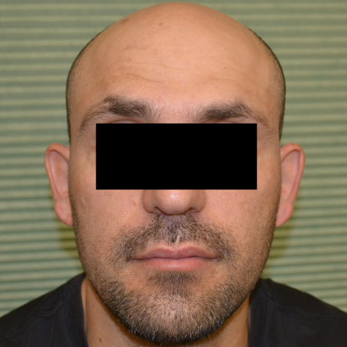 Before otoplasty on male patient headshot case 1054