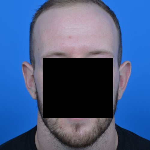 Protruding ears before otoplasty case 1080