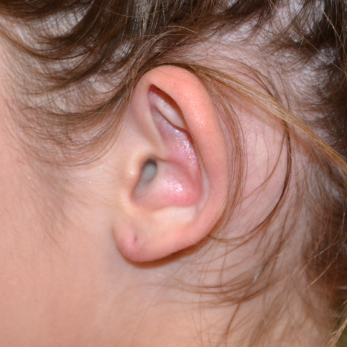 Left ear before otoplasty case 1075