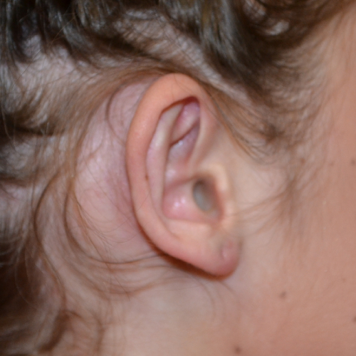 Right ear before otoplasty case 1075