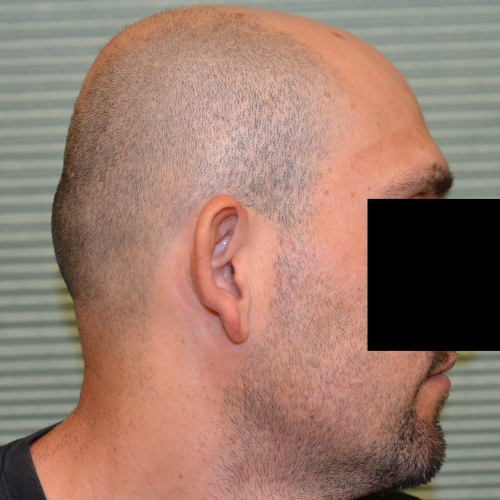 Before otoplasty on male patient profile case 1054