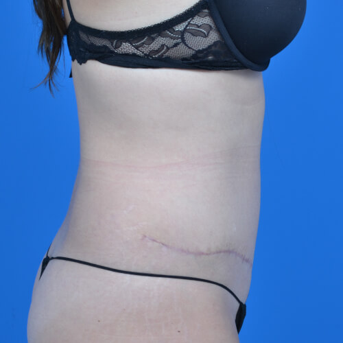 Tummy tuck after right side