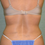Back view of tummy tuck case 1431 after procedure