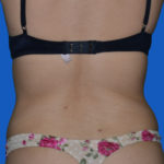 Flanks after tummy tuck case 1546 back view