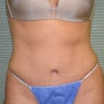 After tummy tuck front view case 1431