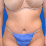 After tummy tuck front view case 1440