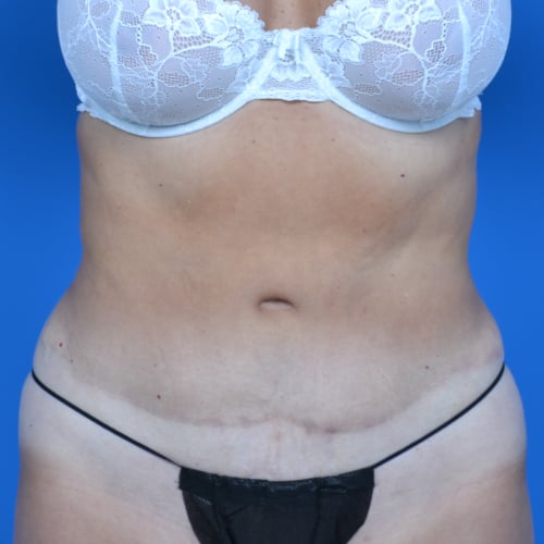 After tummy tuck front view case 1454
