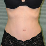 After tummy tuck procedure case 1467, front view