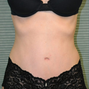 after tummy tuck procedure case 1467, front view