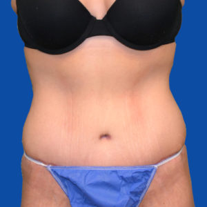 Front view of tummy tuck case 1493