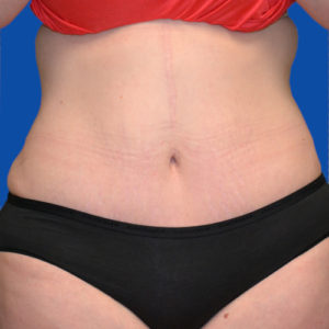 Patient's abs after tummy tuck front view