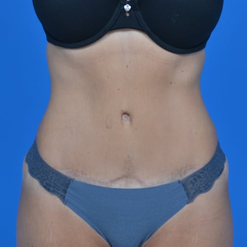 Front view after tummy tuck, case 1600
