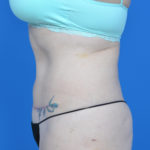 Left side view abs of patient after tummy tuck case 1459