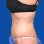 Left side view of tummy tuck case 1493