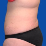 Tummy tuck after left side