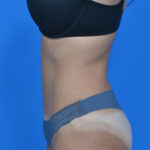 After tummy tuck, patient's left side case 1600