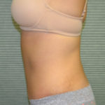 Left side view of patient after tummy tuck