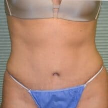 Tummy tuck after photo front view-2