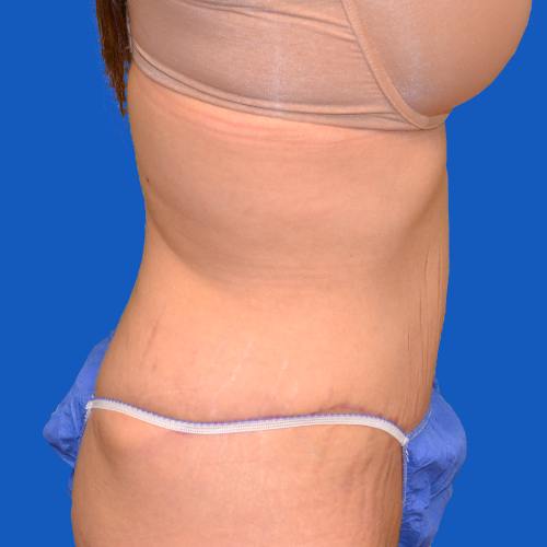 After tummy tuck right side view case 1440