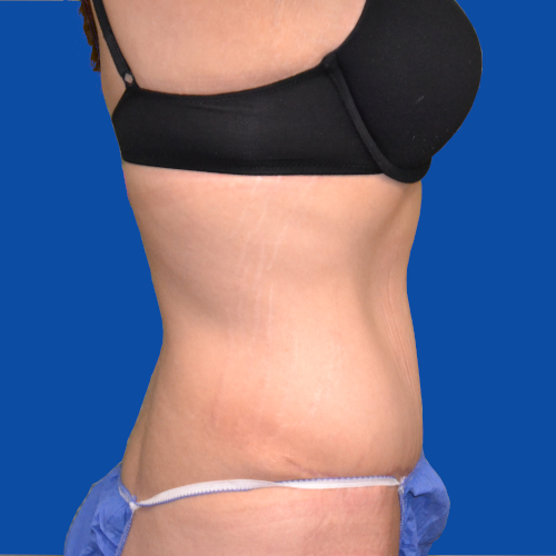 Right side view of tummy tuck case 1493
