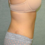 Right side view of patient after tummy tuck