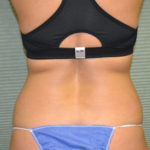 Back view of patient before tummy tuck case 1431