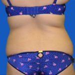 Back view of patient's flanks before tummy tuck, case 1546