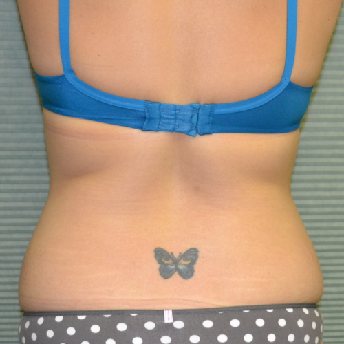 Patient's flanks before tummy tuck