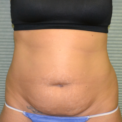 Front view of patient's abs before tummy tuck case 1431