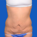 Before tummy tuck front view case 1440