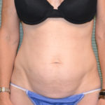 Front view of patient before tummy tuck, case 1467