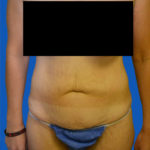Front view before tummy tuck case 1493